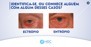 Ectrópio e Entrópio Hospital de Olhos Curvelo